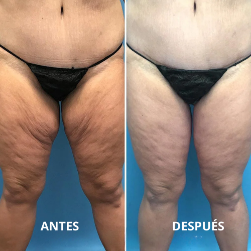 Immunya – Aceite corporal rejuvenecedor